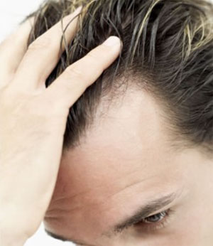 اصلی‌ترین عامل ریزش مو چیست؟