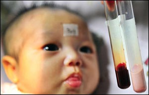 علائم کم خونی در کودکان