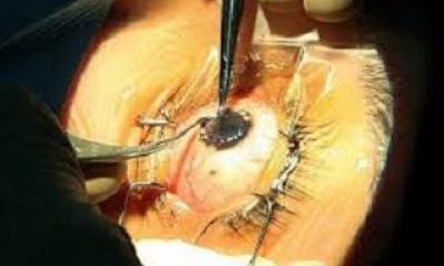 نخستین پیوند قرنیه چشم در لرستان انجام شد